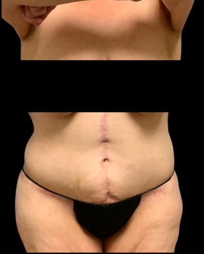 Circumferential Abdomen Before & After Patient #7038