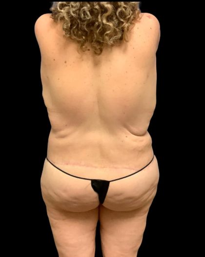Circumferential Abdomen Before & After Patient #7038