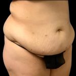 Circumferential Abdomen Before & After Patient #7039