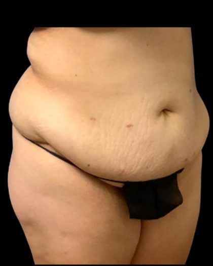 Circumferential Abdomen Before & After Patient #7039