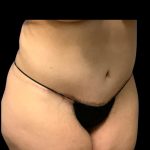Circumferential Abdomen Before & After Patient #7039