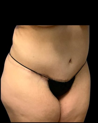 Circumferential Abdomen Before & After Patient #7039