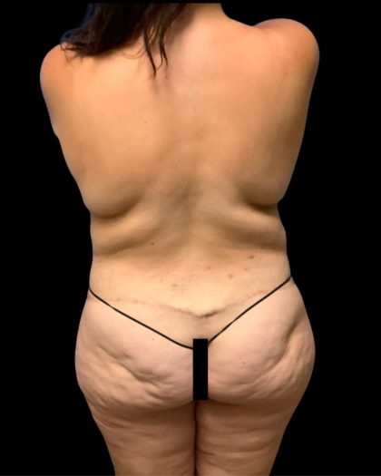 Circumferential Abdomen Before & After Patient #7039