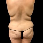 Circumferential Abdomen Before & After Patient #7039