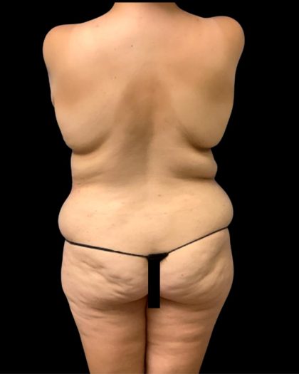 Circumferential Abdomen Before & After Patient #7039