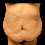 Fleur-de-lis Abdominoplasty Before & After Patient #7040