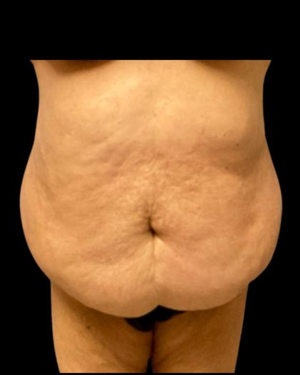Fleur-de-lis Abdominoplasty Before & After Patient #7040