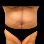 Fleur-de-lis Abdominoplasty Before & After Patient #7040