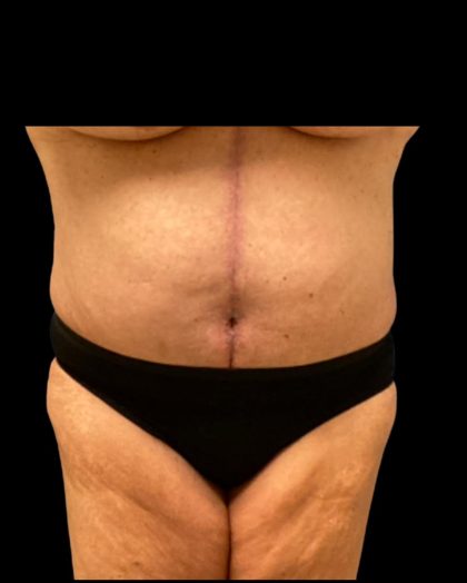 Fleur-de-lis Abdominoplasty Before & After Patient #7040