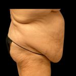 Fleur-de-lis Abdominoplasty Before & After Patient #7040