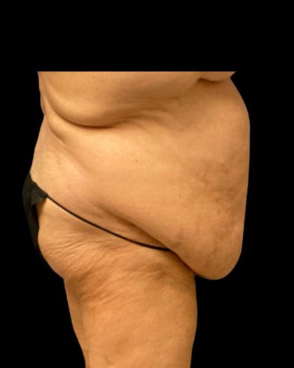 Fleur-de-lis Abdominoplasty Before & After Patient #7040