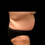 Fleur-de-lis Abdominoplasty Before & After Patient #7040