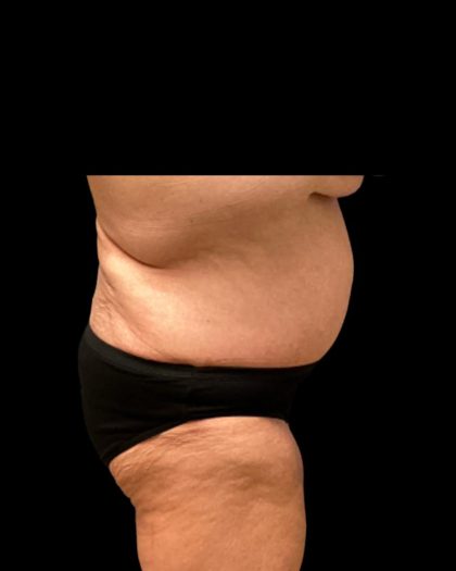 Fleur-de-lis Abdominoplasty Before & After Patient #7040