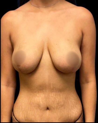 Breast Lift Before & After Patient #7042