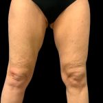 Thigh Lift Before & After Patient #7043