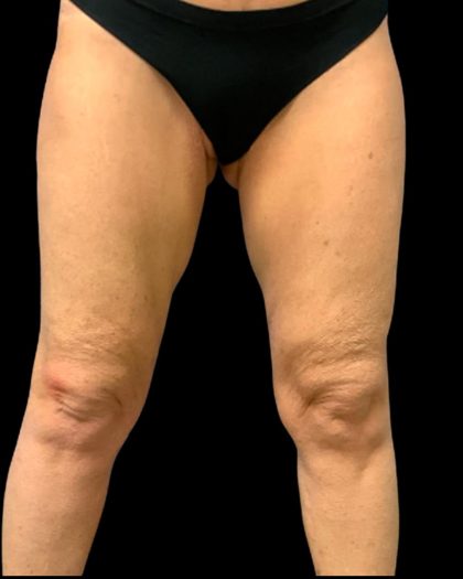 Thigh Lift Before & After Patient #7043