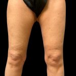 Thigh Lift Before & After Patient #7043