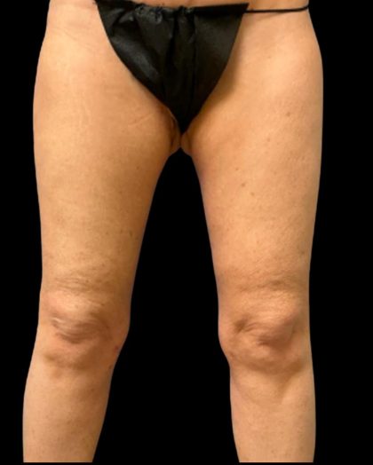 Thigh Lift Before & After Patient #7043
