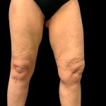 Thigh Lift Before & After Patient #7043