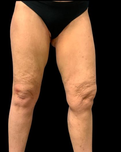 Thigh Lift Before & After Patient #7043