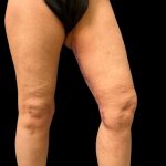 Thigh Lift Before & After Patient #7043