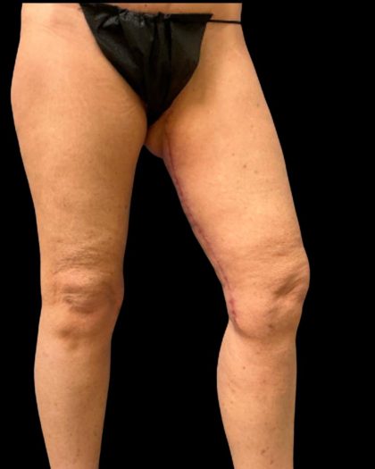 Thigh Lift Before & After Patient #7043