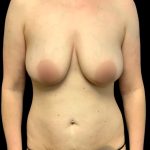 Mommy Makeover Before & After Patient #7230