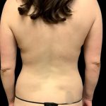 Mommy Makeover Before & After Patient #7230