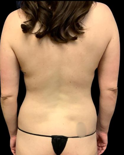 Mommy Makeover Before & After Patient #7230