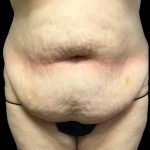 Tummy Tuck Before & After Patient #6973