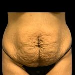 Tummy Tuck Before & After Patient #7027