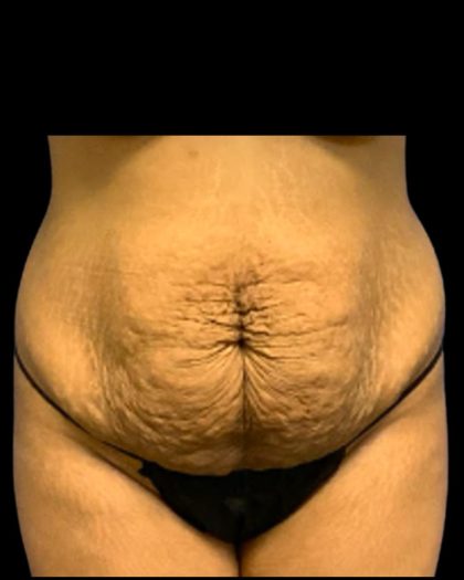 Tummy Tuck Before & After Patient #7027