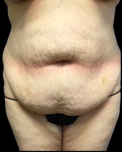 Tummy Tuck Before & After Patient #6973