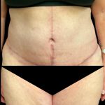 Tummy Tuck Before & After Patient #6973