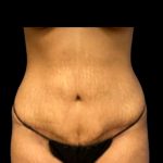 Tummy Tuck Before & After Patient #7027
