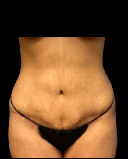 Tummy Tuck Before & After Patient #7027