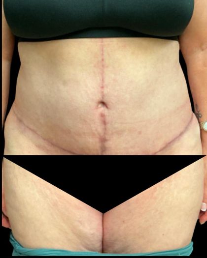 Tummy Tuck Before & After Patient #6973