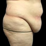 Tummy Tuck Before & After Patient #6973