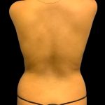 Tummy Tuck Before & After Patient #7027