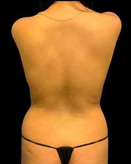 Tummy Tuck Before & After Patient #7027