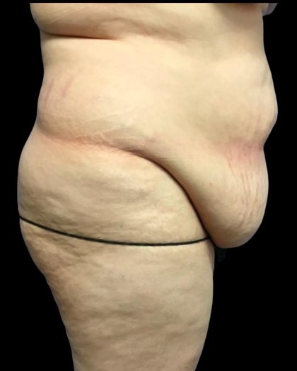Tummy Tuck Before & After Patient #6973
