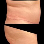 Tummy Tuck Before & After Patient #6973