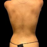 Tummy Tuck Before & After Patient #7027