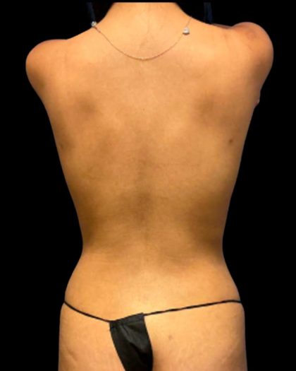 Tummy Tuck Before & After Patient #7027