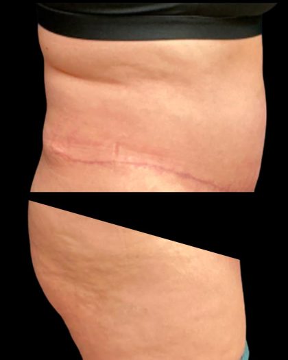 Tummy Tuck Before & After Patient #6973