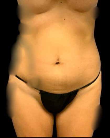 Tummy Tuck Before & After Patient #7231