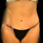 Tummy Tuck Before & After Patient #7231
