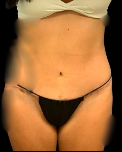 Tummy Tuck Before & After Patient #7231