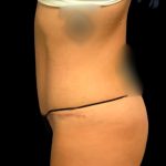 Tummy Tuck Before & After Patient #7231