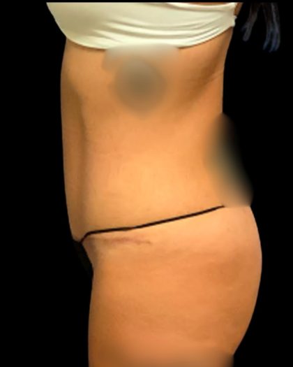 Tummy Tuck Before & After Patient #7231